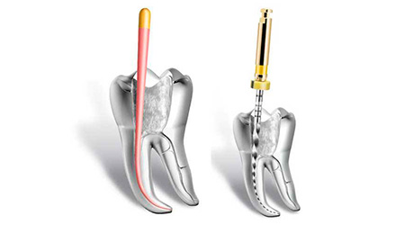 Foto Tratamento Endodontia (Canal) - Dra. Juliana Montes - Odontologia Koza