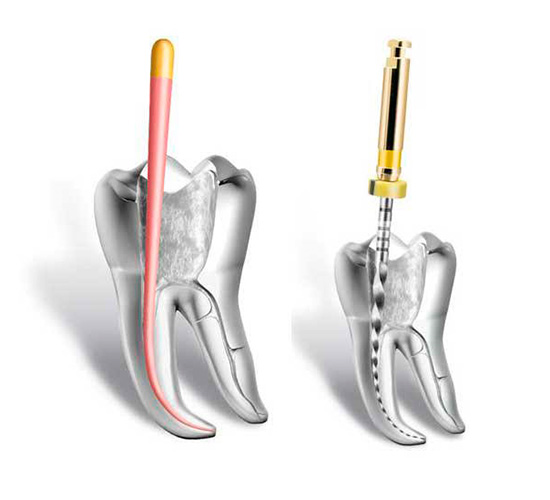 Foto Tratamento Endodontia (Canal) - Dra Juliana Montes - Odontologia