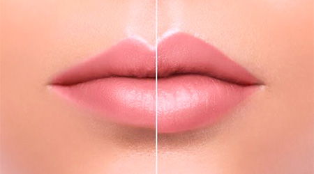 Foto Tratamento Preenchimento Labial - Dra. Juliana Montes - Odontologia Koza
