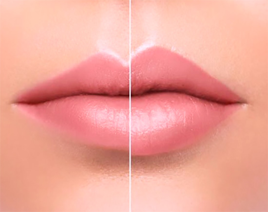 Foto Tratamento Preenchimento Labial - Dra Juliana Montes - Odontologia